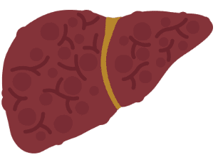Icon of liver with severe fibrosis stage F3